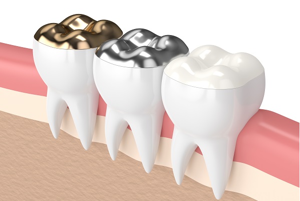 Dental Filling Services in Calgary
