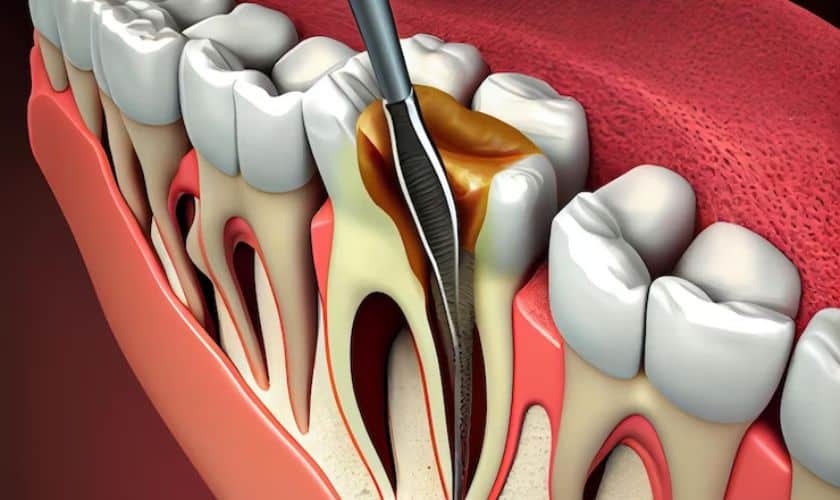 dental root canal services