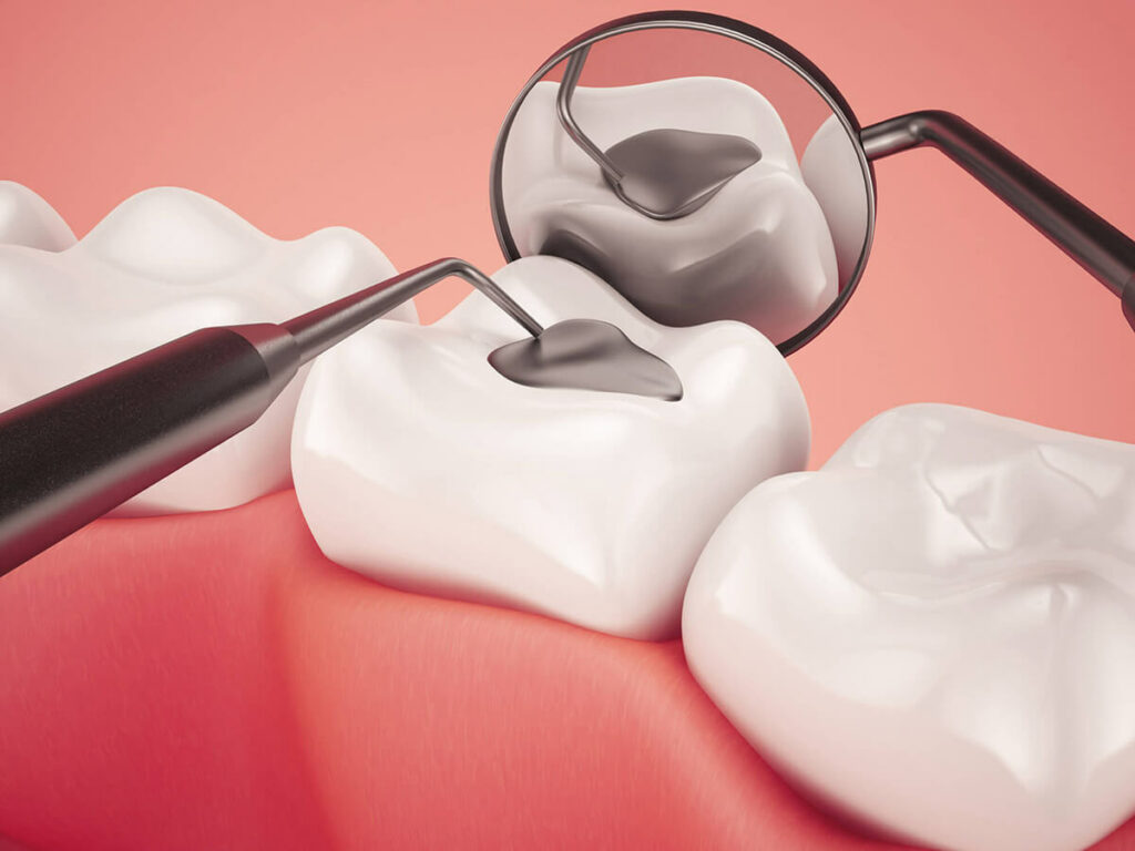 The Positive Aspects of Incorporating Dental Sealants