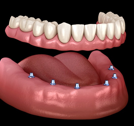 implant-dentures-2