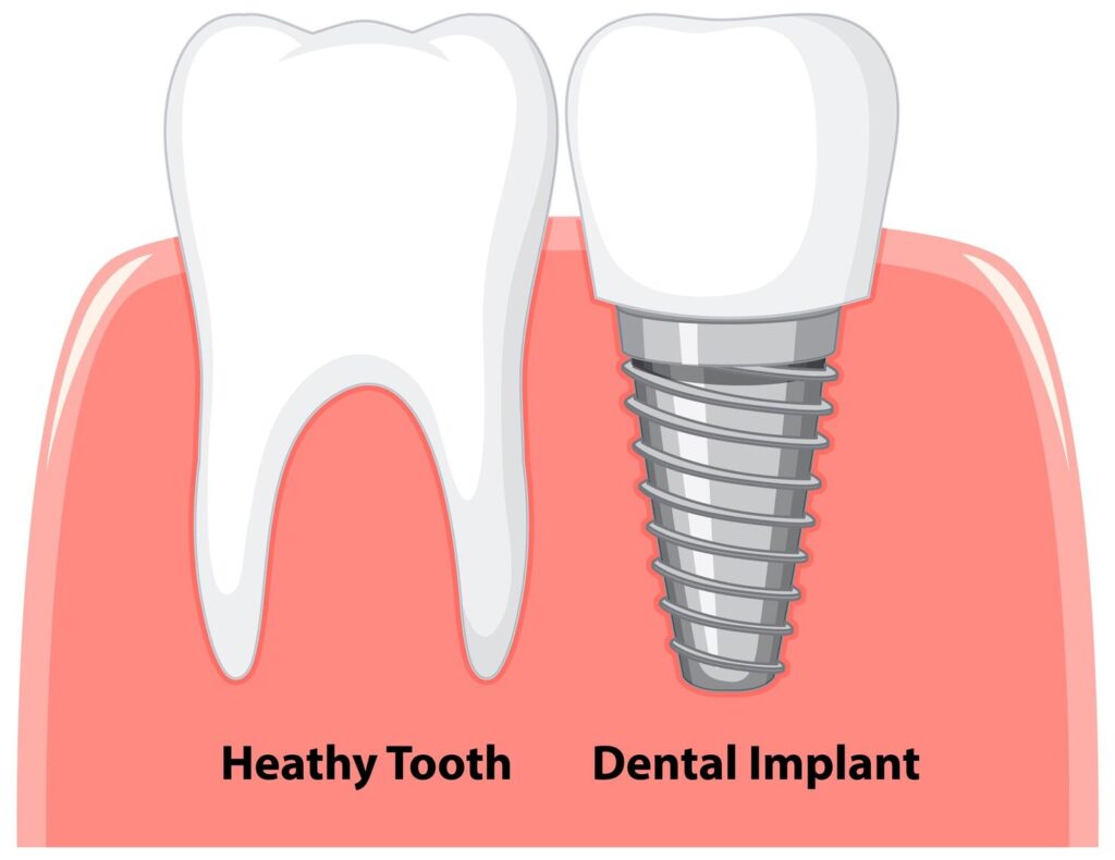 Dental Implants