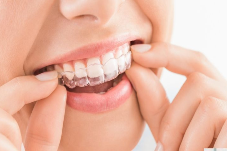 Maximize Invisalign Results in Calgary