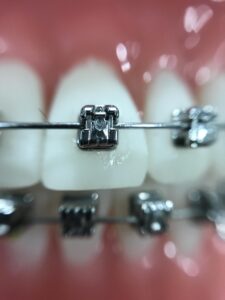 Orthodontic Braces