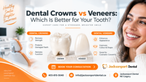 Dental Crowns vs Veneers Calgary: Which Is Better?